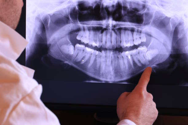 Best Emergency Wisdom Tooth Extraction in Opelousas, LA